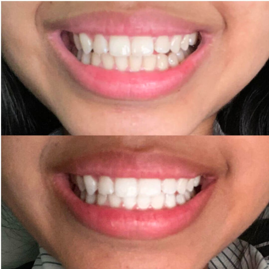 Teeth Whitening Pen 3.0